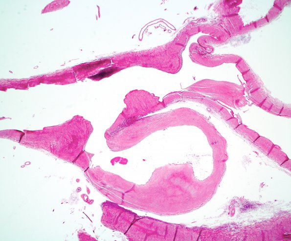 7B2 Aneurysm, ACA (Case 7) H&E whole mount 2X