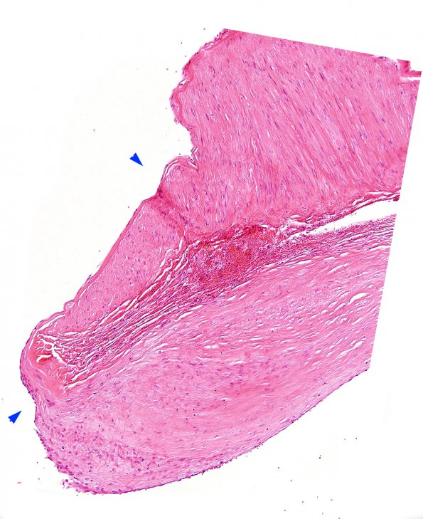 7B3 Aneurysm, ACA (Case 7) H&E 1 copy A