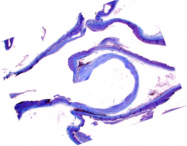 7B4 Aneurysm, ACA (Case 7) Trichrome whole mount 2X