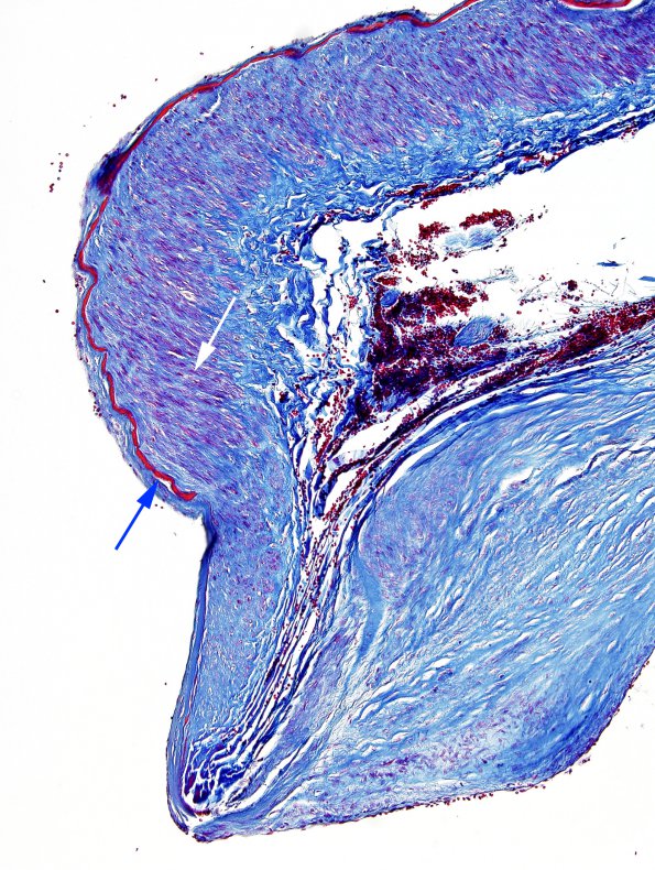 7B5 Aneurysm, ACA (Case 7) Trichrome 1 copy