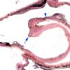 7B6 Aneurysm (Case 7) VVG whole mount 2X reshot copy