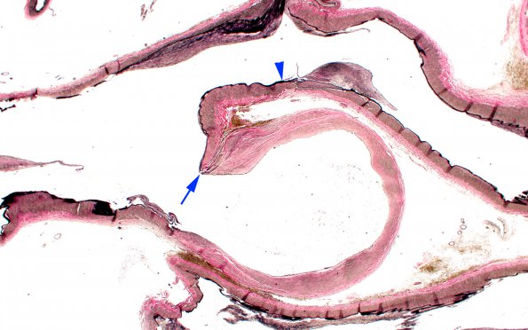 7B6 Aneurysm (Case 7) VVG whole mount 2X reshot copy