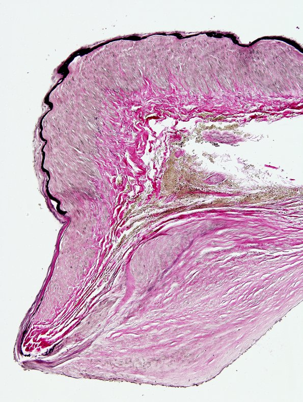 7B7 Aneurysm, ACA (Case 7) VVG 1