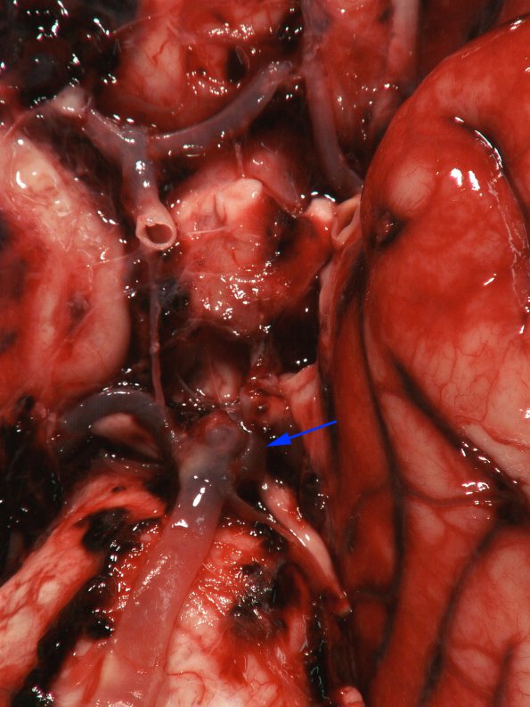 8A2 Aneurysm, tip basilar & SAH (Case 8) Gross_3 copy