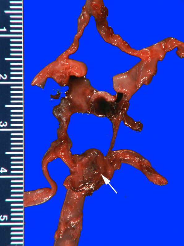 8A3 Aneurysm, tip basilar & SAH (Case 8) Gross_7