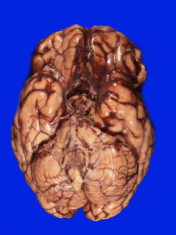 9A1 Aneurysm ACA-ACommunicating & SAH (Case 9) 3