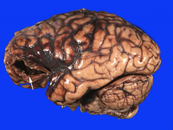 9A2 Aneurysm ACA-ACommunicating & SAH (Case 9) 4 copy