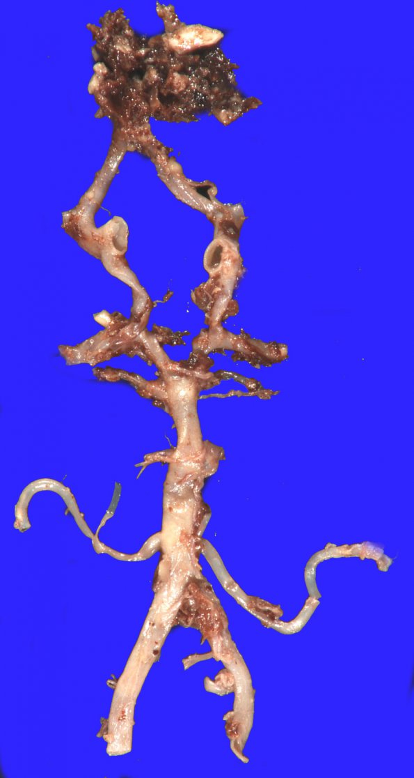 9A4 Aneurysm ACA-ACommunicating & SAH (Case 9) 5