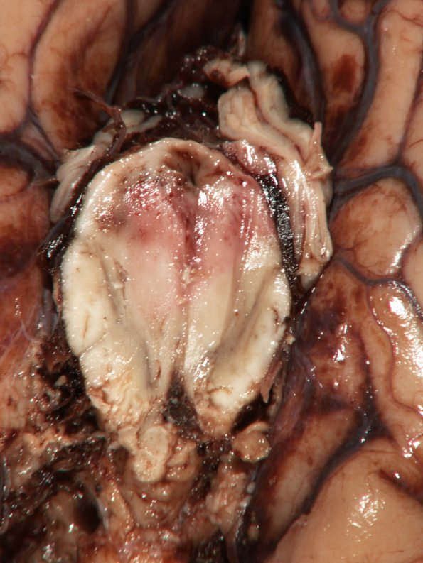 9A5 Aneurysm ACA-ACommunicating & SAH (Case 9) 7