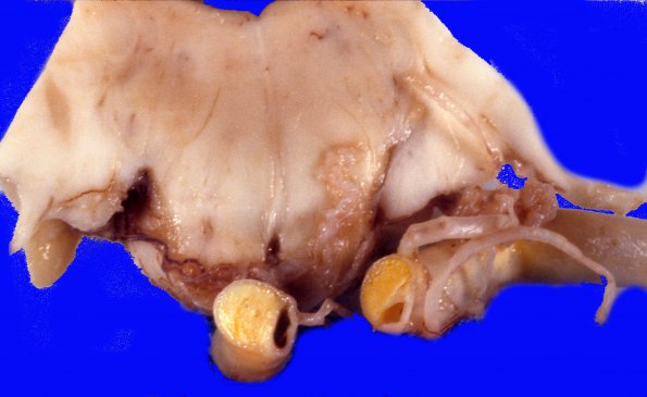 10 Atherosclerosis, basilar (Case 10)