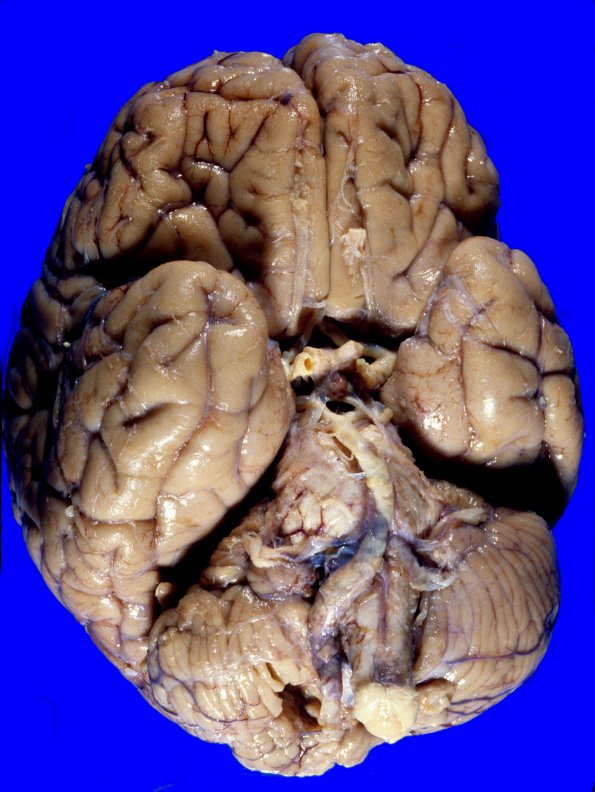 12A1 Atherosclerosis (Case 12) carotid 3