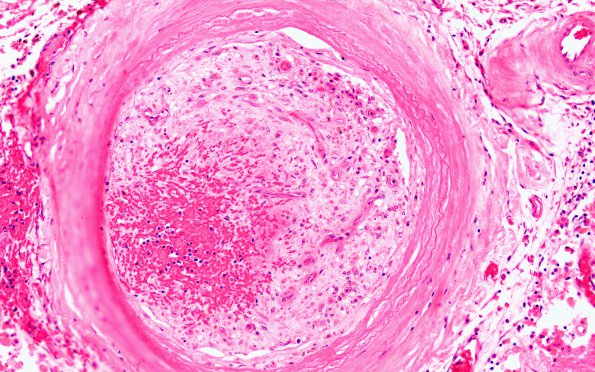 12B4 Atherosclerosis (Case 12) E fusiform gyrus 20X