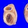 13A1 Atherosclerosis, Int Carotid (Case 13)