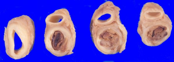 13A1 Atherosclerosis, Int Carotid (Case 13)