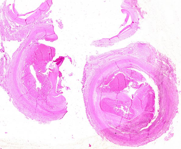 13A2 Atherosclerosis, Internal Carotid (Case 13) H&E