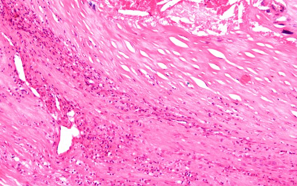 13A3 Atherosclerosis, occlusion LICA (Case 13) H&E 20X 1