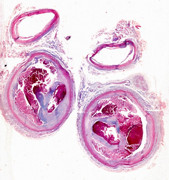 13B1 Atherosclerosis, occlusion LICA (Case 13) Trichrome 1