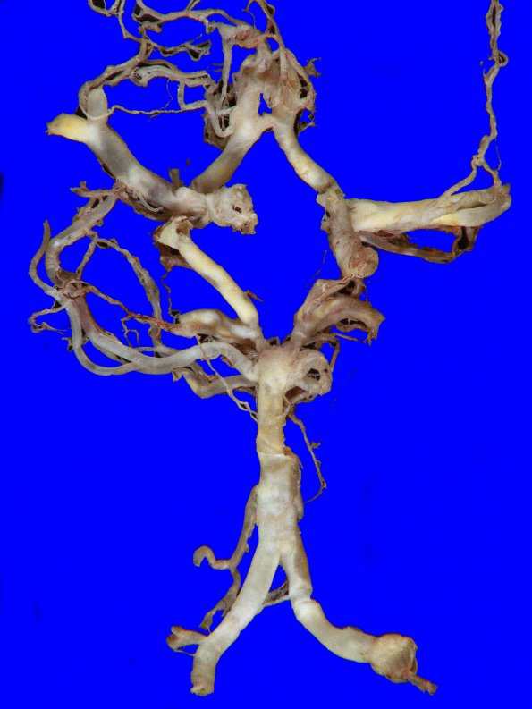 14A2 Atherosclerosis, HT & DM (Case 14)_7