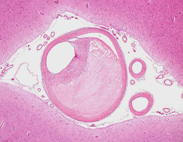 14B2 Atherosclerosis, HT & DM (Case 14) H&E 1