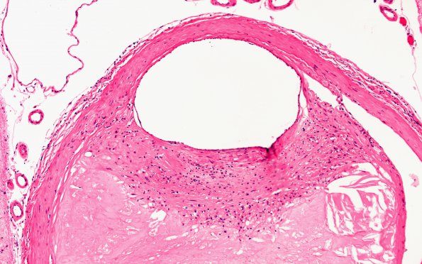 14B3 Atherosclerosis, HT & DM (Case 14) 10X