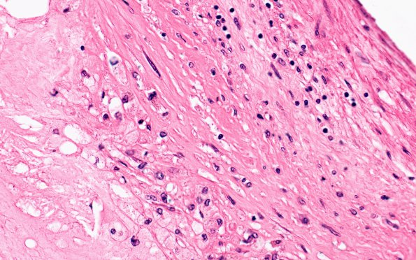 14B4 Atherosclerosis, HT & DM (Case 14) 40X