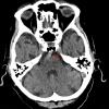 15A1 Atherosclerosis (Case 15) CT 2 copy - Copy