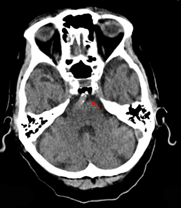 15A1 Atherosclerosis (Case 15) CT 2 copy - Copy