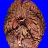 15B1 Atherosclerosis (Case 15) _1