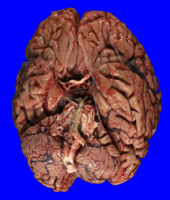 15B1 Atherosclerosis (Case 15) _1