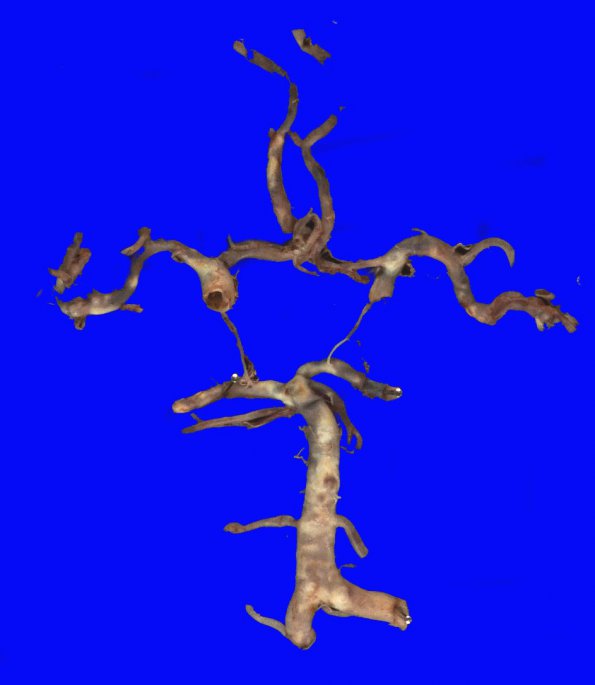 15B2 Atherosclerosis (Case 15) Gross _2