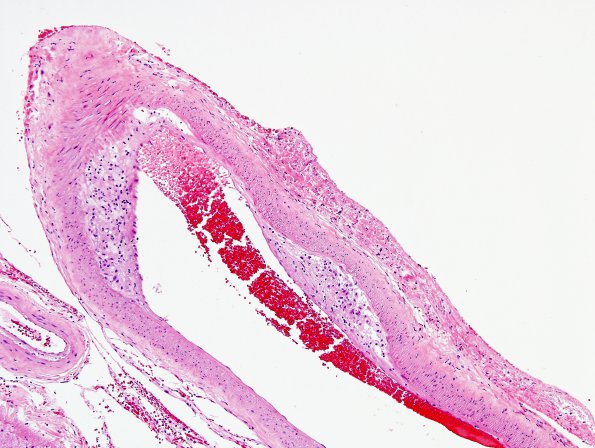 16B1 Atherosclerosis, small vessels (DM, HT, smoking, Case 16) H&E 8