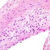 16B2 Atherosclerosis, small vessels (DM, HT, smoking, Case 16) H&E 10