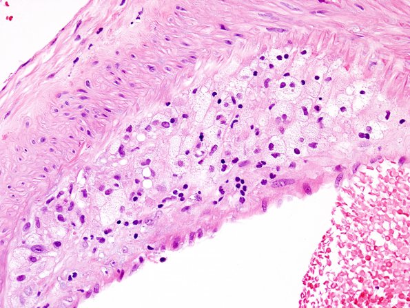 16B2 Atherosclerosis, small vessels (DM, HT, smoking, Case 16) H&E 10