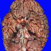 17A1 Infarct, remote, atherosclerosis, AD (Case 17) _1