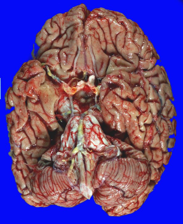 17A1 Infarct, remote, atherosclerosis, AD (Case 17) _1