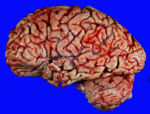 17A2 Infarct, remote, atherosclerosis, AD (Case 17) _2