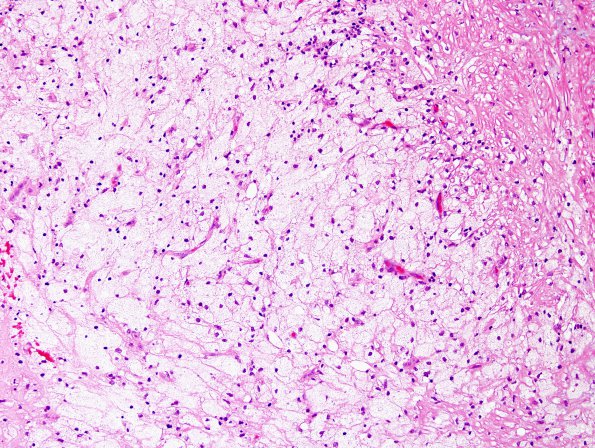 18A2 Atherosclerosis, endarterectomy (Case 18) H&E 1