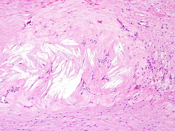 18A3 Atherosclerosis, endarterectomy (Case 18) H&E 2