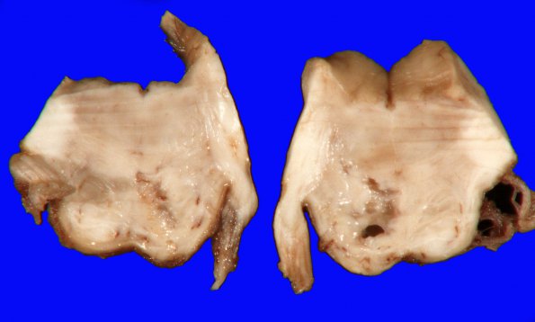 19A3 (Case 19) Gross