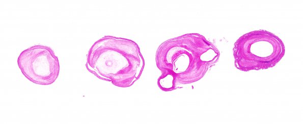 19B1 Infarcts, multiple, subacute (Case 19) N16 H&E 1 Atherosclerosis WM