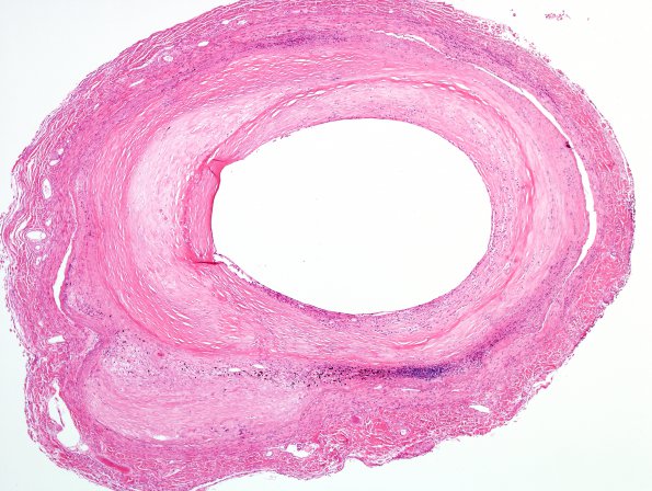 19B2 Infarcts, multiple, subacute  (Case 19) N16 H&E 2 atherosclerosis