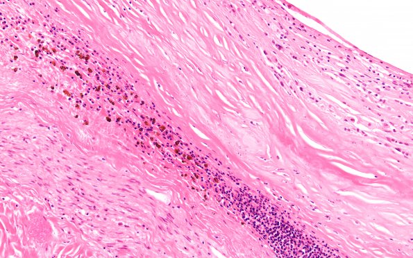 19B3 Infarcts, multiple, subacute (Case 19) N16 H&E 20X 1