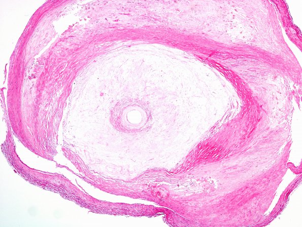 19B4 Infarcts, multiple, subacute  (Case 19) N16 H&E 4 atherosclerosis