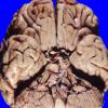 1A1 Hypoxia-Ischemia, Laminar Necrosis (Case 1)  1