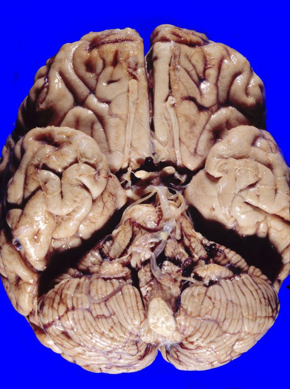 1A1 Hypoxia-Ischemia, Laminar Necrosis (Case 1)  1