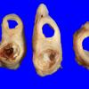 1A2 Atherosclerosis, carotid, internal, occluded (Case 1) gross