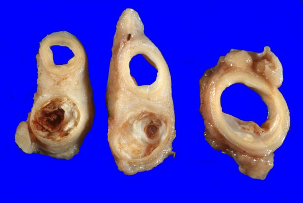 1A2 Atherosclerosis, carotid, internal, occluded (Case 1) gross