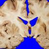 1A3 Infarct, subacute (Case 1) (2)