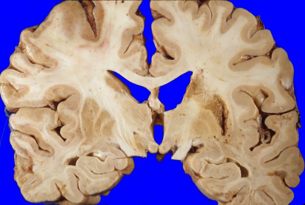 1A3 Infarct, subacute (Case 1) (2)