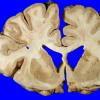 1A4 Hypoxia-Ischemia, Laminar Necrosis (Case 1) 2 copy